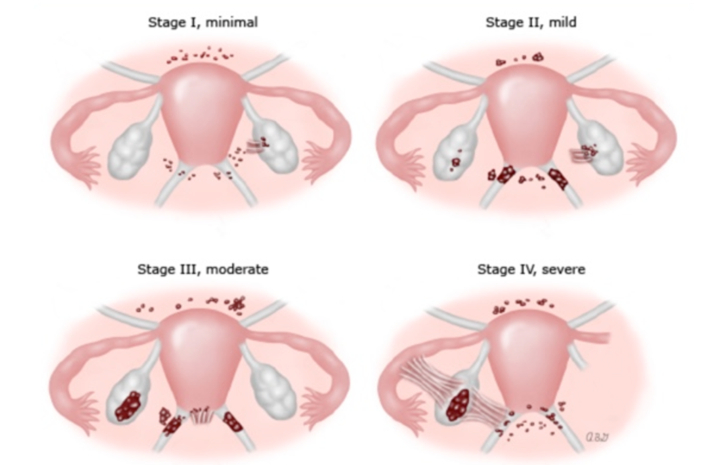 Endometriozisin Evreleri